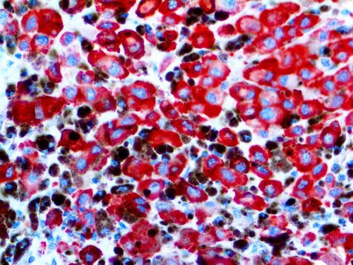 IHC of Melanoma / PNL2 on an FFPE Melanoma Tissue